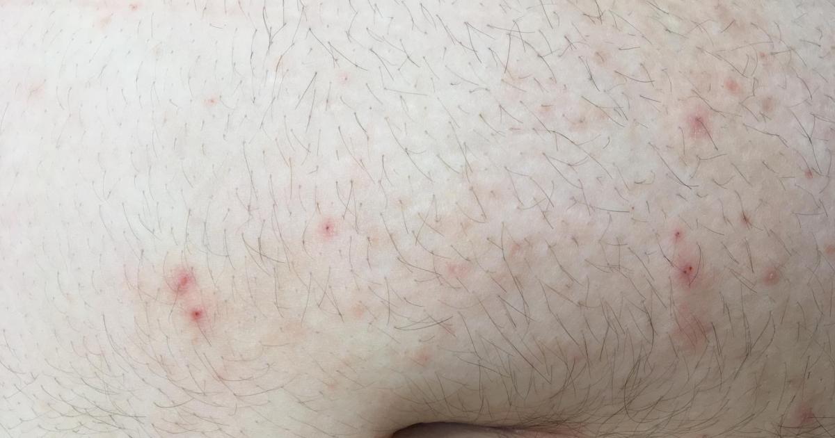 Svrab (scabies) | Dermaweb