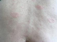 Pytiriasis  rosea